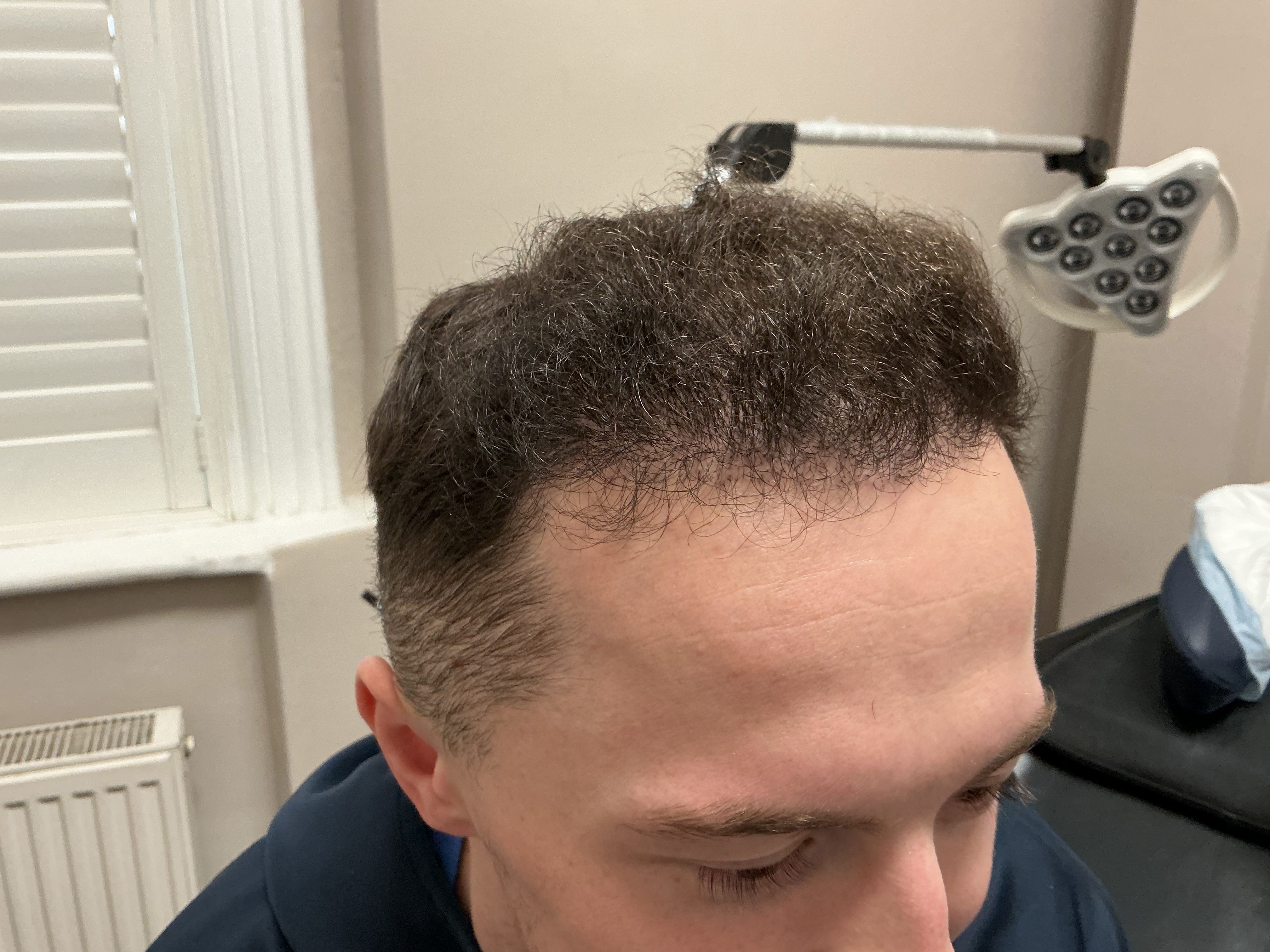 Advanced hairline recession — result photo 12